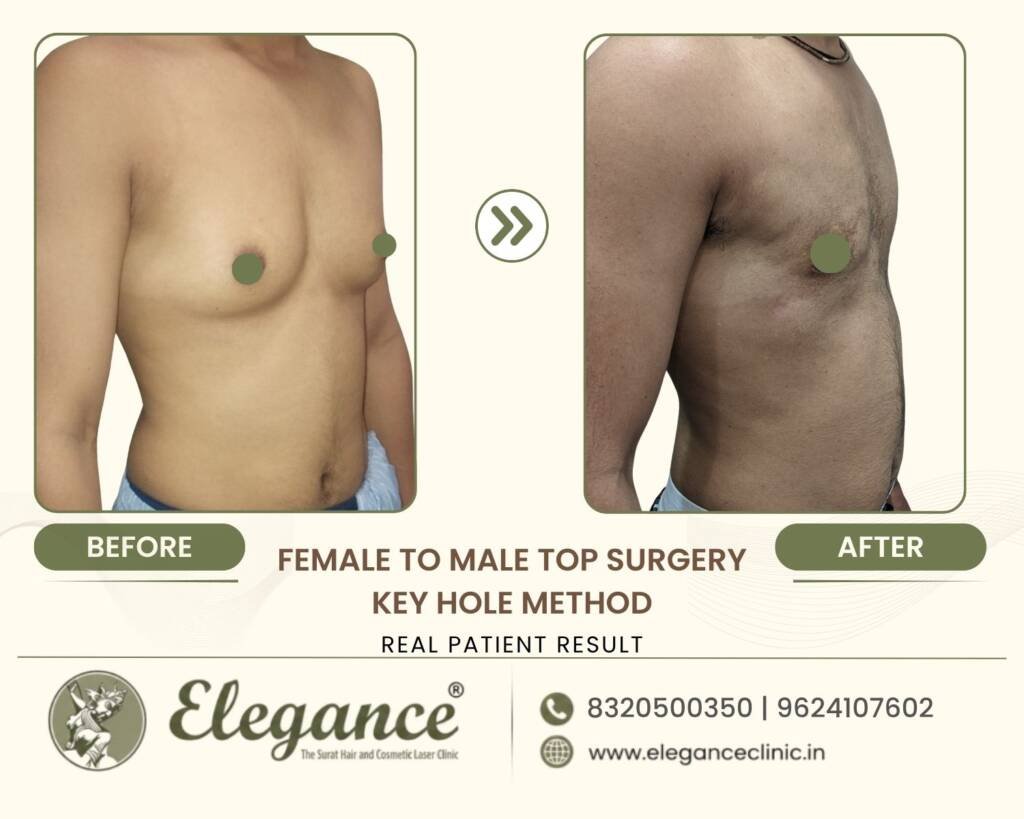 Keyhole-Top-Surgery