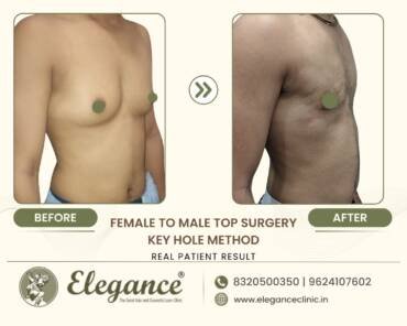 Keyhole-Top-Surgery