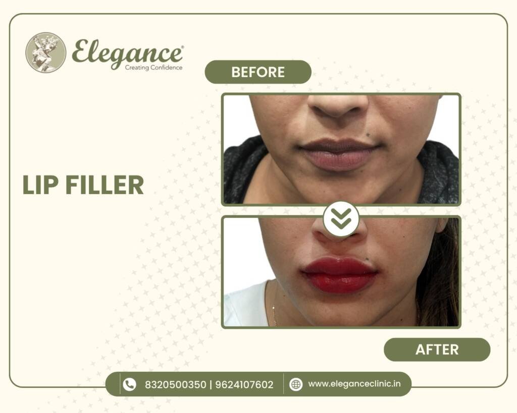 Lip-Filler