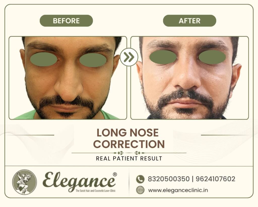 Long-Nose-Correction