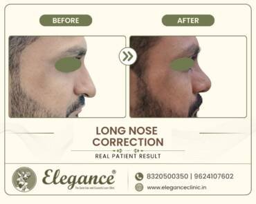 Long Nose- Rhinoplasty
