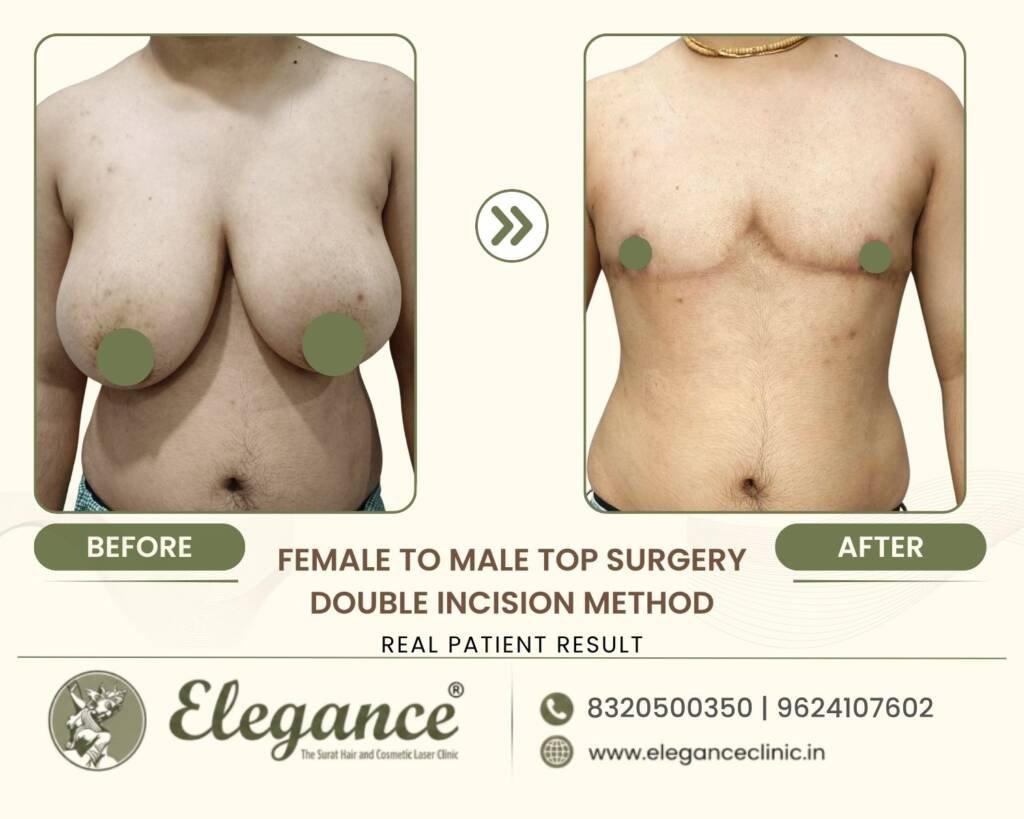Masculinizing-Chest-Double-Incision