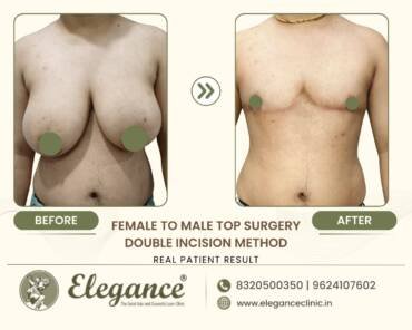 Masculinizing-Chest-Double-Incision
