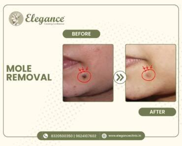 Mole-Removal-Cheek