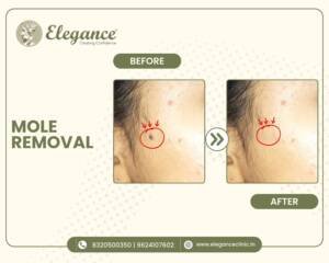 Mole-Removal-Facial