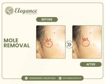 Mole-Removal-Facial