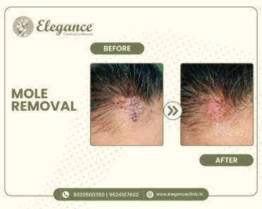 Mole-Removal-Scalp