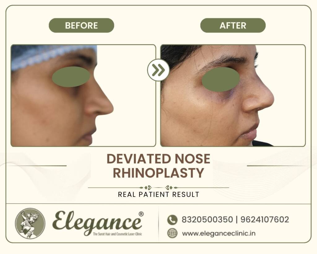 Nasal-Deviation-Correction
