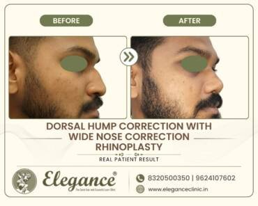 Nasal-Hump-Width-Correction