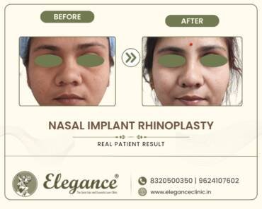 Nasal-Implant-Rhinoplast