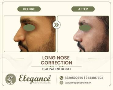 nasal -length-reduction