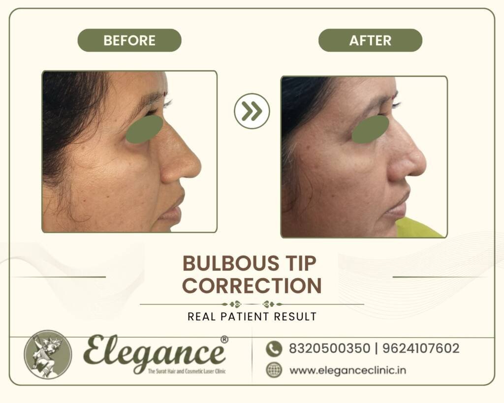 Nasal-Tip-Refinemen