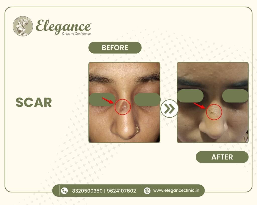Nose-Scar-Treatment
