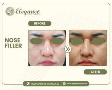 NoseFacial Treatment