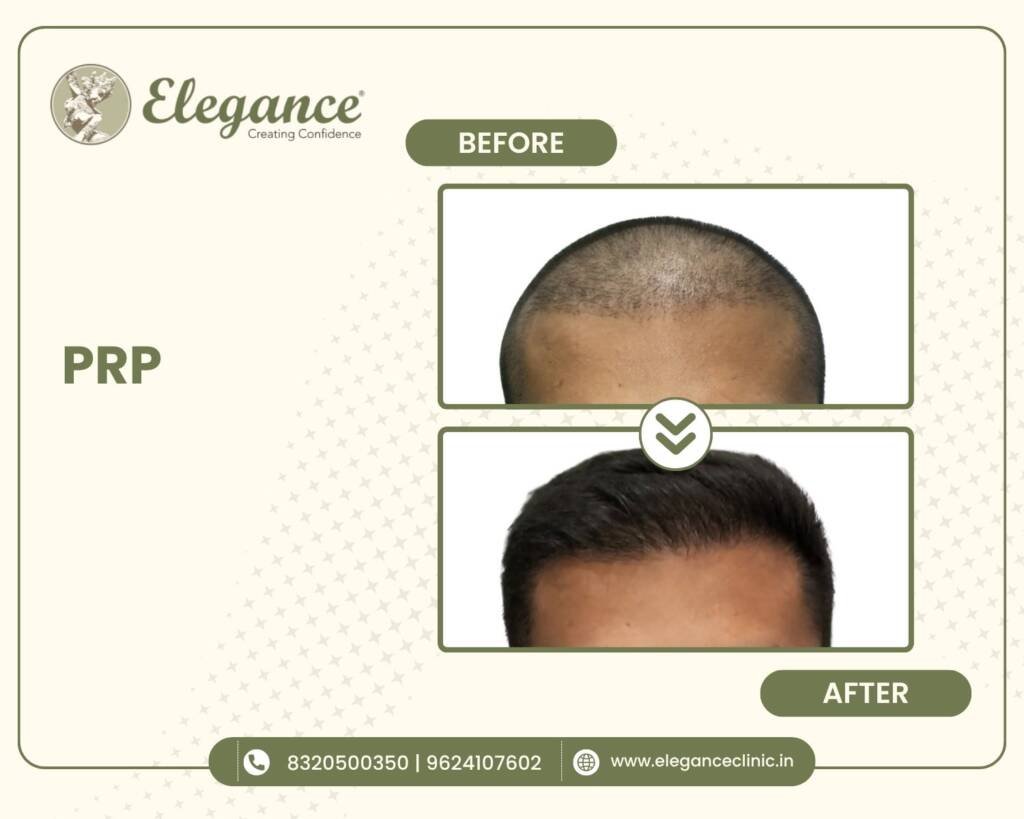 PRP-Hair-Treatment