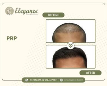 PRP-Hair-Treatment