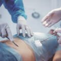 Fat Removal Surgery in Surat: Why It Is Contouring, Not Weight Loss