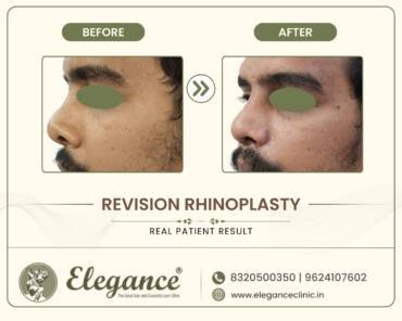 Revision-Rhinoplasty