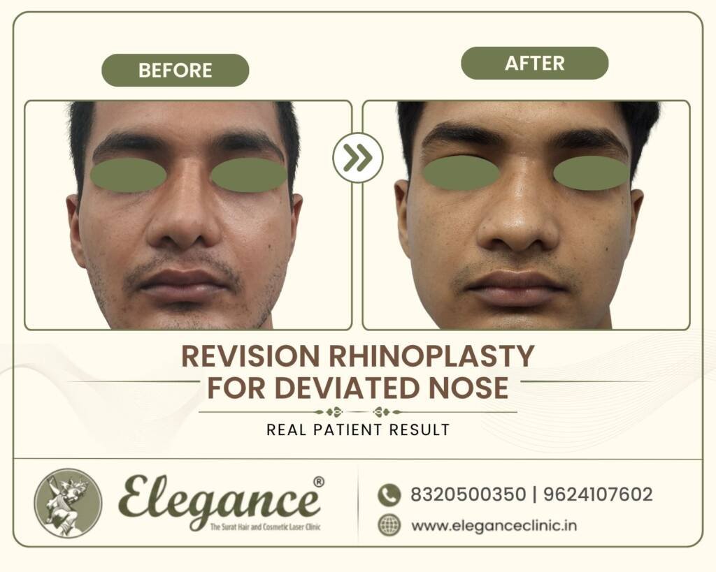 Revision-Rhinoplasty-Deviated-Nose-Front
