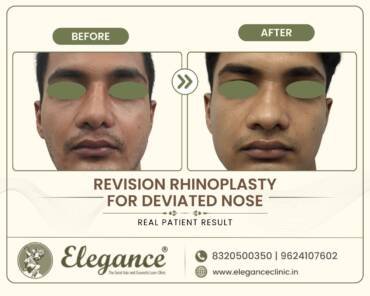 Revision-Rhinoplasty-Deviated-Nose-Front