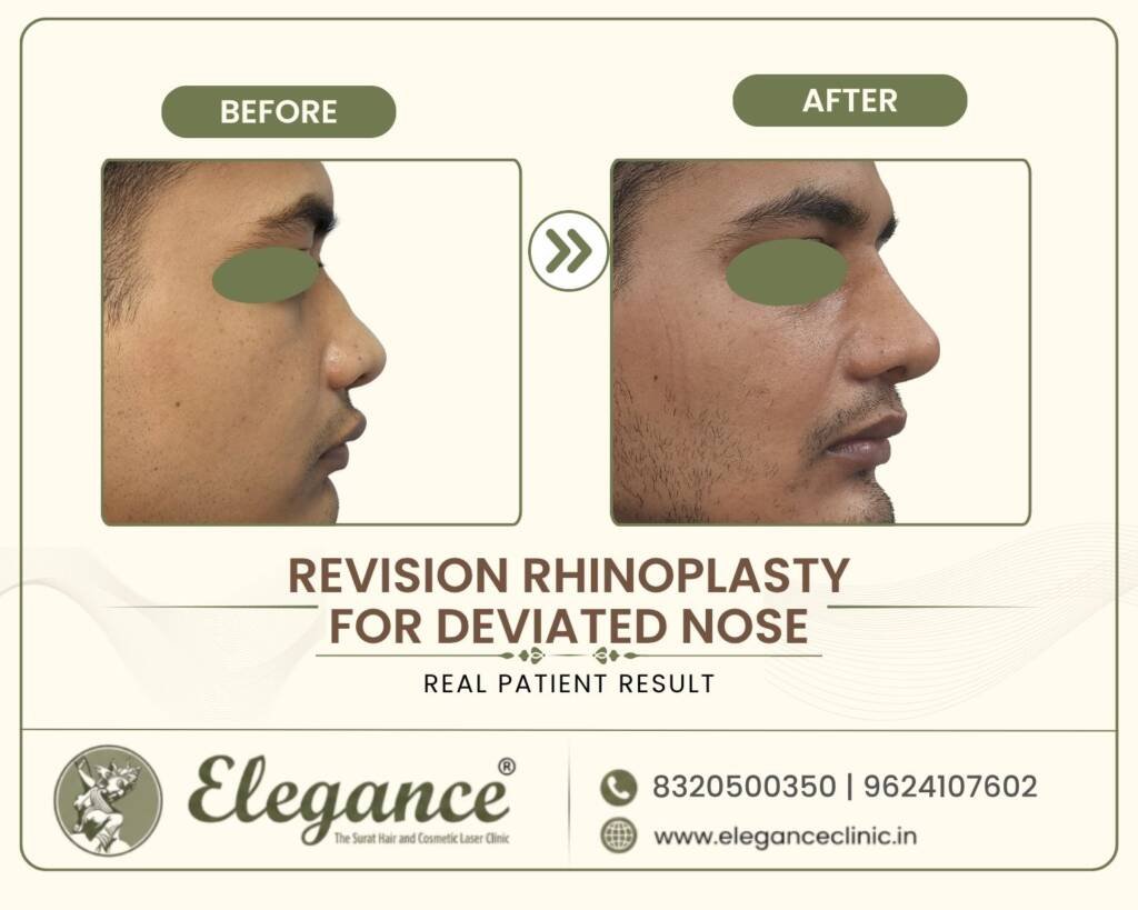 Revision-Rhinoplasty-Deviated-Nose-Profile