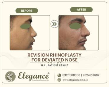Revision-Rhinoplasty-Deviated-Nose-Profile