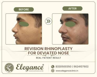 Revision-Rhinoplasty-Deviated-Nose-Side