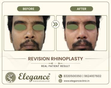 Revision-Rhinoplasty-Front-View