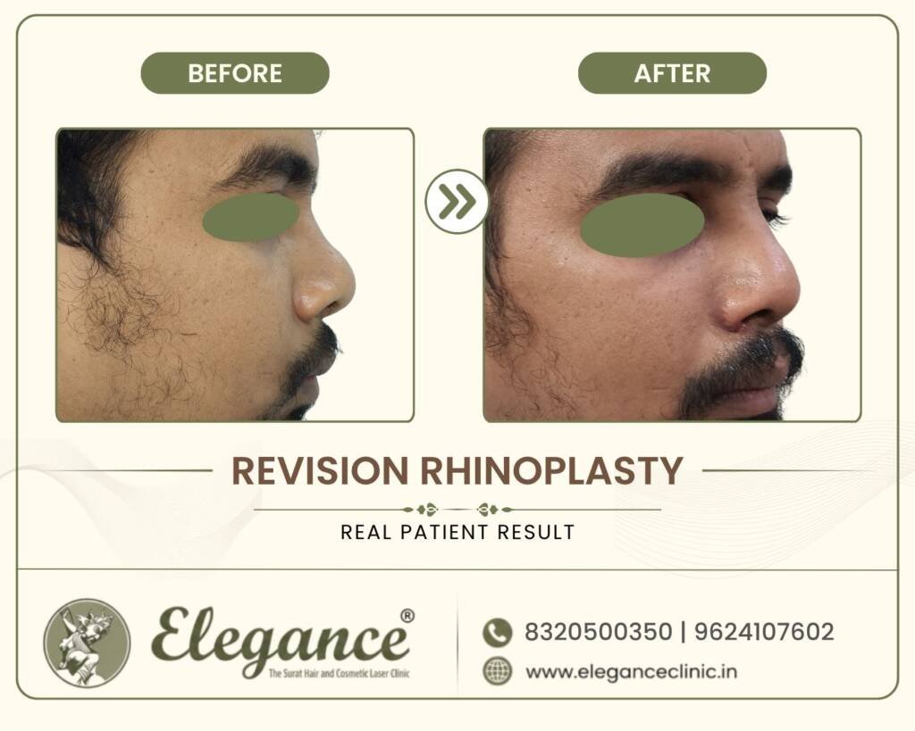Revision-Rhinoplasty-Side-View