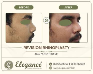 Revision-Rhinoplasty-Side-View