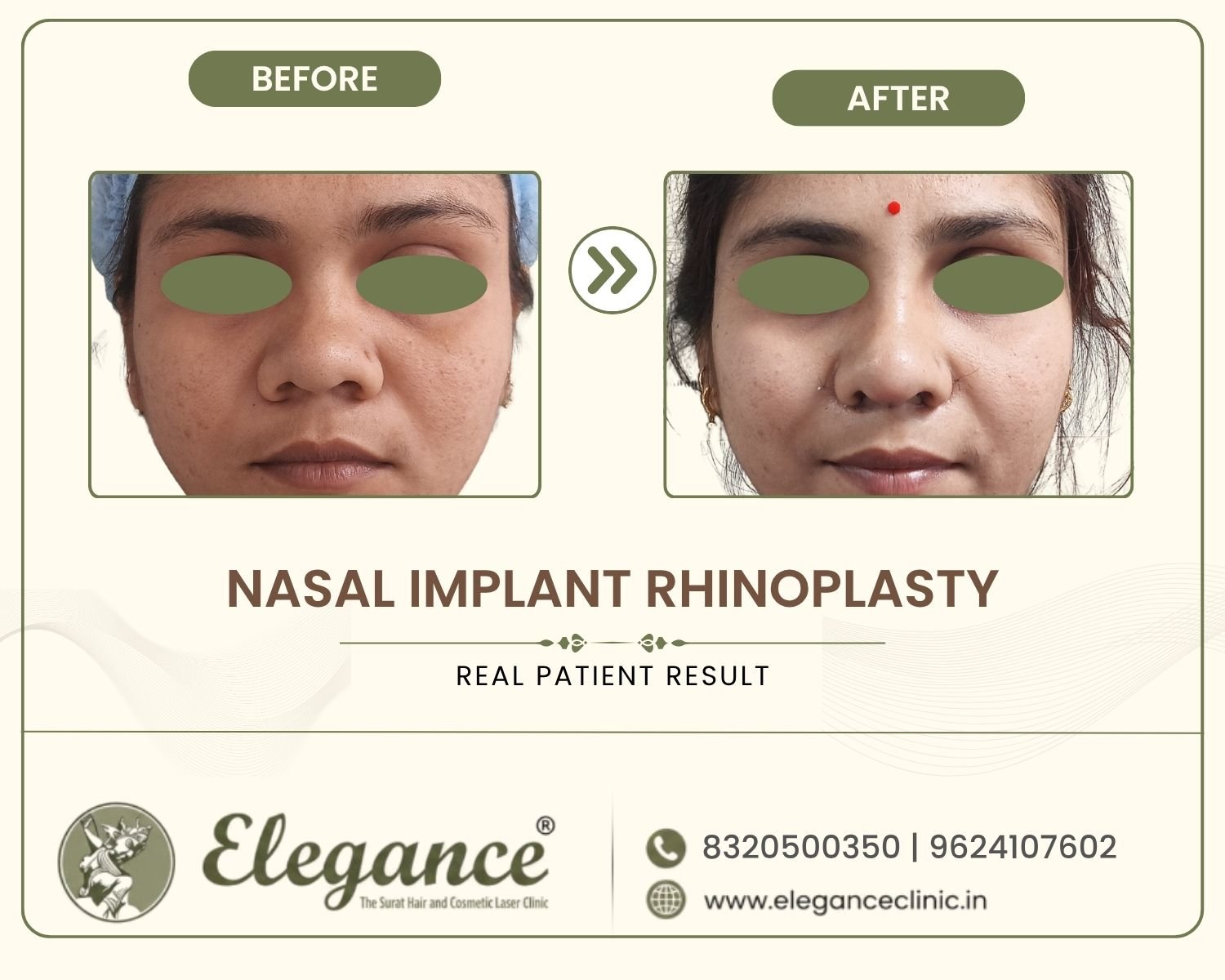Rhinoplasty