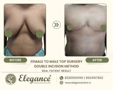 Top surgery