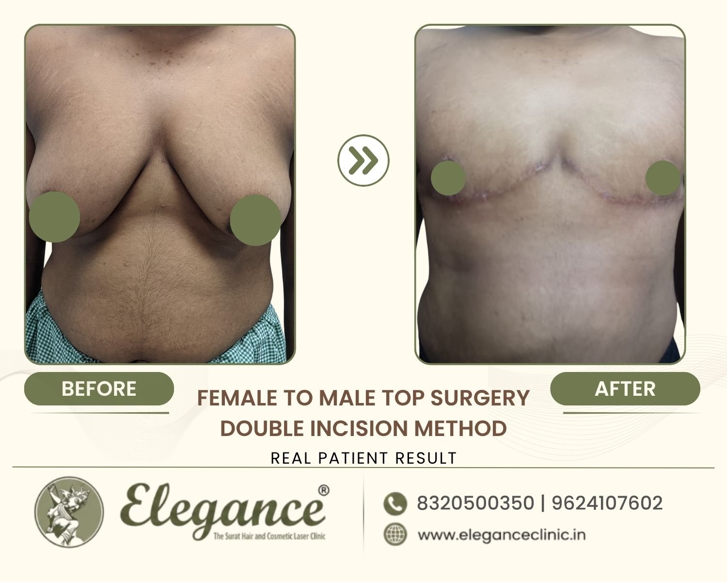Transgender surgery