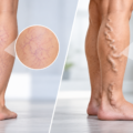 Spider Veins or Varicose Veins? How to Tell a Cosmetic Problem From Venous Disease