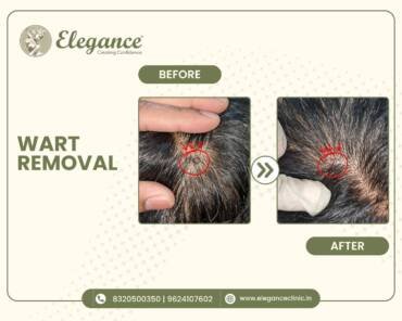 Wart-Removal-Scalp
