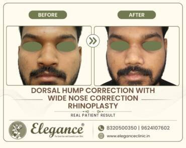 Wide-Nose-Rhinoplasty
