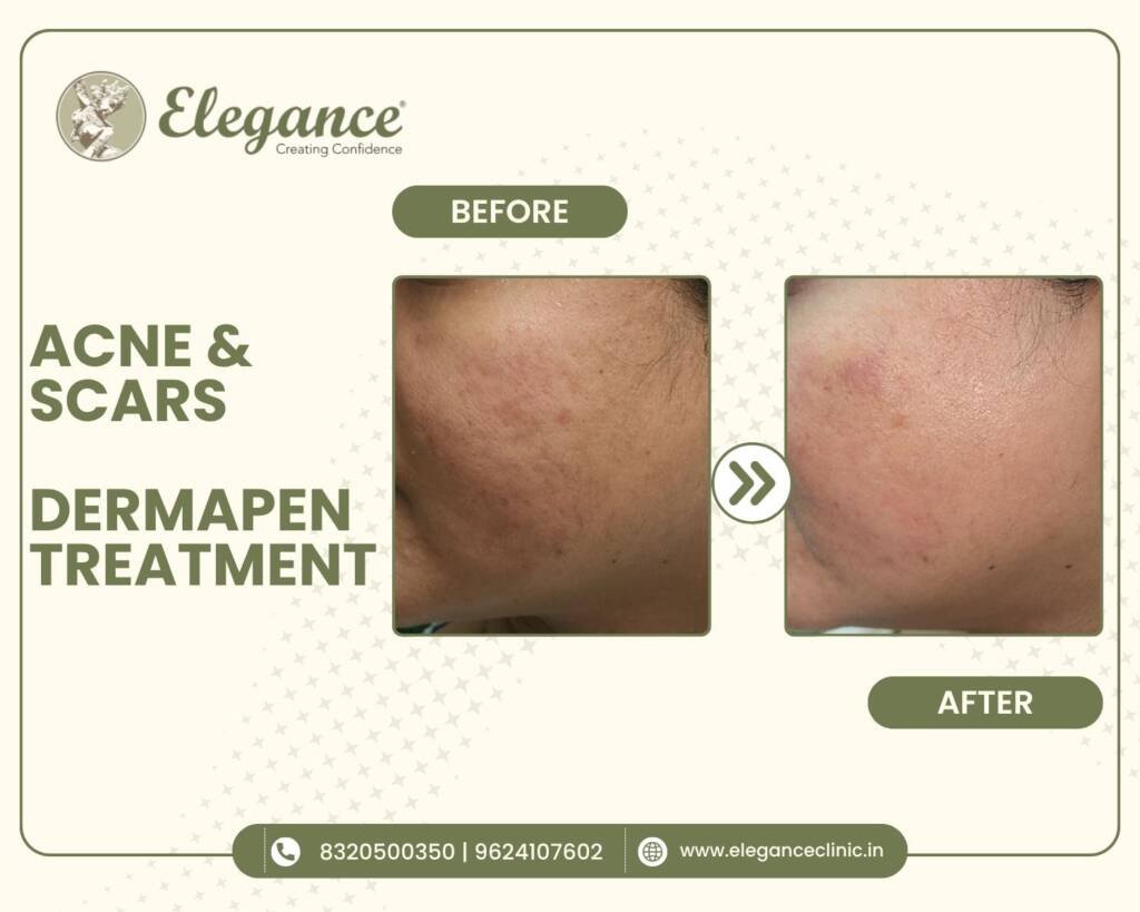 acne-scars-dermapen-treatment