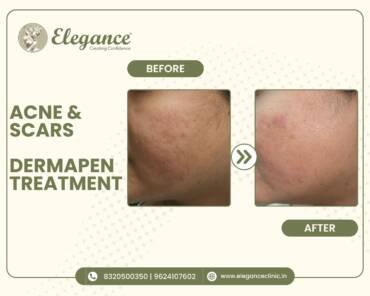 acne-scars-dermapen-treatment