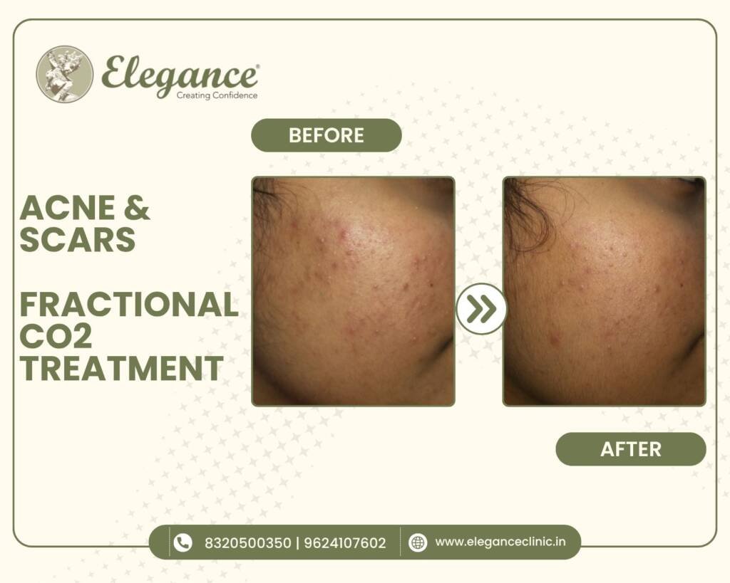acne-scars-fractional-co2-treatment