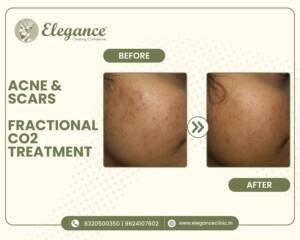 acne-scars-fractional-co2-treatment