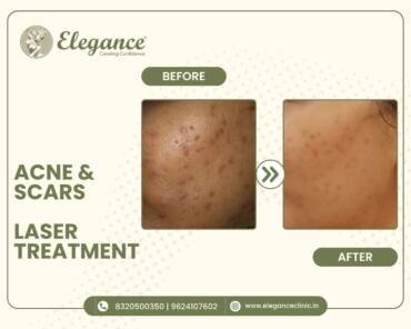 acne-scars-laser-treatment