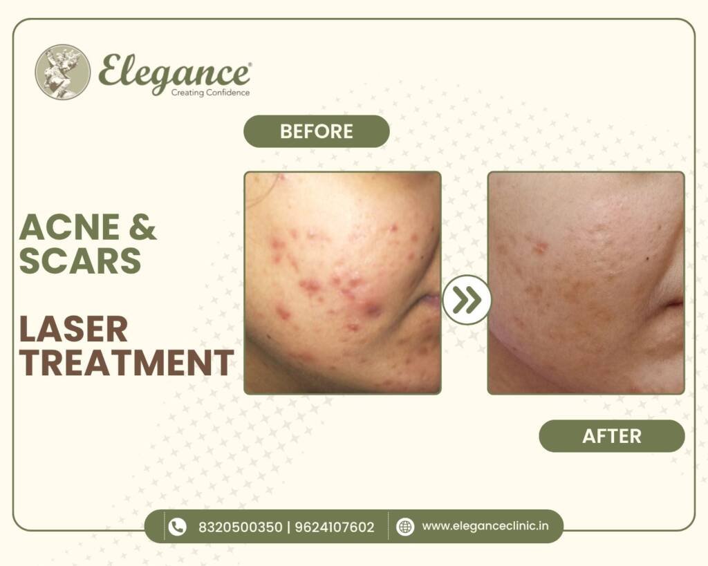 acne-scars-laser-treatment (2)