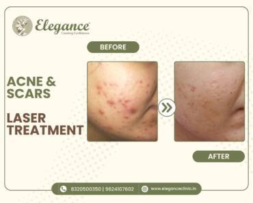 acne-scars-laser-treatment (2)