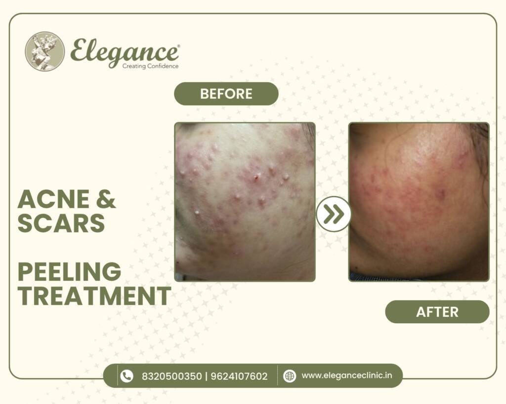 acne-scars-peeling-treatment