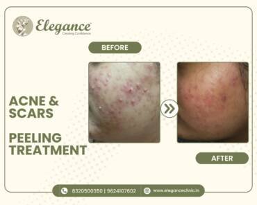acne-scars-peeling-treatment