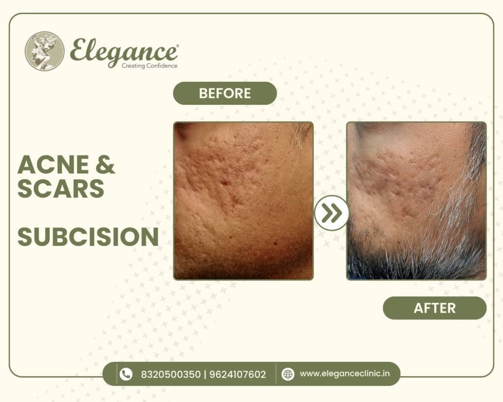 acne-scars-subcision