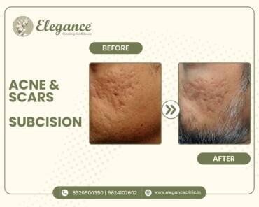 acne-scars-subcision