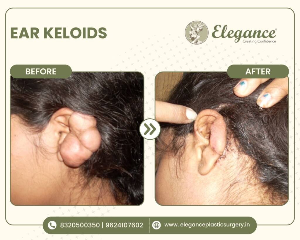 ear keloids