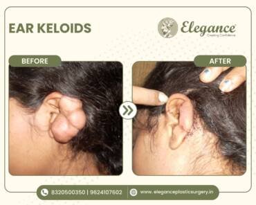 ear keloids