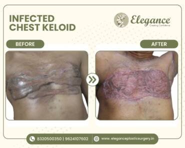 infected chest keloid